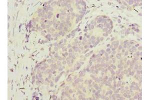 Immunohistochemistry of paraffin-embedded human gastric cancer using ABIN7175802 at dilution of 1:100 (WDR89 antibody  (AA 1-387))