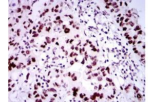 Immunohistochemical analysis of paraffin-embedded endometrial cancer tissues using TP53BP1 mouse mAb with DAB staining. (TP53BP1 antibody  (AA 574-773))