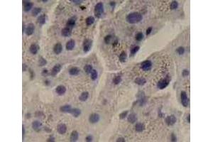 Immunohistochemical staining of human liver cancer tissue section with IL6 monoclonal antibody, clone 1  at 1:10 dilution. (IL-6 antibody)