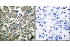 Immunohistochemistry analysis of paraffin-embedded human breast carcinoma, using WNK1 (Phospho-Thr58) Antibody. (WNK1 antibody  (pThr60))