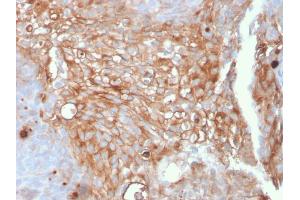 Formalin-fixed, paraffin-embedded human Urothelial Carcinoma stained with Uroplakin 1A Mouse Monoclonal Antibody (UPK1A/2925). (UPK1A antibody  (AA 114-173))
