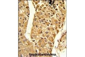 Formalin-fixed and paraffin-embedded human hepatocarcinoma reacted with CYP2C18 Antibody (C-term) ,which was peroxidase-conjugated to the secondary antibody, followed by DAB staining. (CYP2C18 antibody  (C-Term))