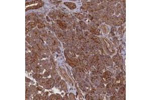 Immunohistochemical staining of human pancreas with ZNF646 polyclonal antibody  shows strong cytoplasmic and membranous positivity in exocrine glandular cells at 1:500-1:1000 dilution.