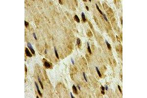 Immunohistochemical analysis of PP1 beta staining in human esophageal cancer formalin fixed paraffin embedded tissue section. (Serine/threonine-Protein Phosphatase PP1-beta Catalytic Subunit (PP1-BETA) antibody)