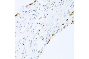 Immunohistochemistry of paraffin-embedded human lung using SFTPC antibody. (Surfactant Protein C antibody)