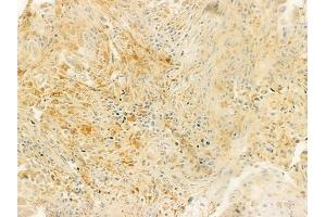 ABIN6263748 and ABIN6279343 at 1/100 staining human lung squamous cell carcinoma by IHC-P. (NT5C2 antibody  (Internal Region))