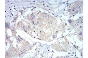 Immunohistochemical analysis of paraffin-embedded liver cancer tissues using FOXP3 mouse mAb with DAB staining. (FOXP3 antibody  (AA 297-431))