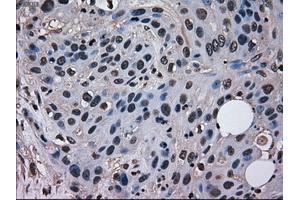 Immunohistochemical staining of paraffin-embedded Adenocarcinoma of breast tissue using anti-MRI1 mouse monoclonal antibody. (MRI1 antibody)