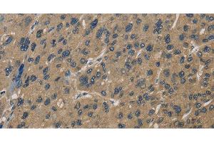 Immunohistochemistry of paraffin-embedded Human liver cancer using CORO1C Polyclonal Antibody at dilution of 1:60 (CORO1C antibody)
