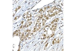 Immunohistochemistry of paraffin-embedded human breast cancer using SNRPD1 Rabbit pAb (ABIN7270363) at dilution of 1:50 (40x lens). (SNRPD1 antibody  (AA 1-100))