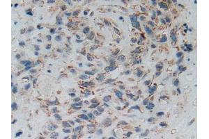 IHC-P analysis of Human Lung Cancer Tissue, with DAB staining. (SMAD5 antibody  (AA 210-464))