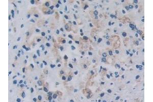 Detection of RARS in Human Prostate cancer Tissue using Polyclonal Antibody to Arginyl tRNA Synthetase (RARS) (RARS antibody  (AA 1-146))
