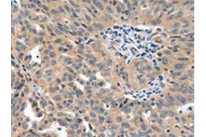 The image on the left is immunohistochemistry of paraffin-embedded Human ovarian cancer tissue using ABIN7191763(P2RY6 Antibody) at dilution 1/40, on the right is treated with synthetic peptide. (P2RY6 antibody)