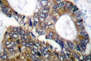 Immunohistochemical analysis of paraffin-embedded human colon cancer tissue using HSPH1 polyclonal antibody . (HSPH1 antibody)