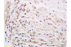 Formalin-fixed and paraffin embedded human gastric carcinoma labeled with Anti-Wnt1 Polyclonal Antibody, Unconjugated (ABIN733748) at 1:200 followed by conjugation to the secondary antibody and DAB staining. (WNT1 antibody  (AA 251-350))