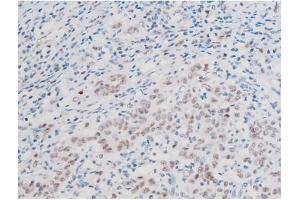 ABIN6267555 at 1/200 staining Human ganstric cancer tissue sections by IHC-P.