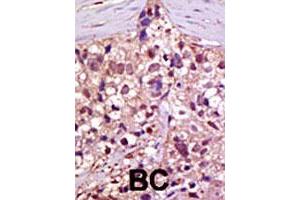 Formalin-fixed and paraffin-embedded human cancer tissue reacted with UBA1 polyclonal antibody  , which was peroxidase-conjugated to the secondary antibody, followed by AEC staining. (UBA1 antibody  (C-Term))