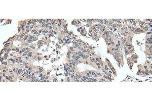 Immunohistochemistry of paraffin-embedded Human colorectal cancer tissue using TRIM23 Polyclonal Antibody at dilution of 1:55(x200) (TRIM23 antibody)