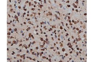 ABIN6269160 at 1/200 staining human lymph cancer tissue sections by IHC-P.