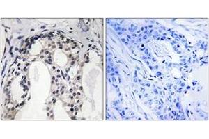 Immunohistochemistry analysis of paraffin-embedded human breast carcinoma, using Merlin (Phospho-Ser10) Antibody. (Merlin antibody  (pSer10))