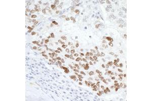 Immunohistochemistry (IHC) image for anti-Tumor Protein P53 (TP53) (AA 50-100) antibody (ABIN7454600)