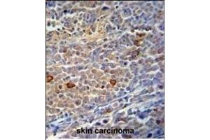 C9orf156 Antibody (C-term) (ABIN390925 and ABIN2841127) immunohistochemistry analysis in formalin fixed and paraffin embedded human skin carcinoma followed by peroxidase conjugation of the secondary antibody and DAB staining. (C9orf156 antibody  (C-Term))