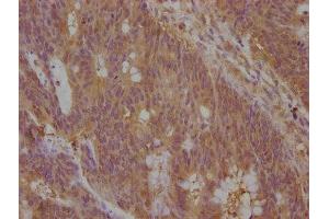 IHC image of ABIN7139936 diluted at 1:100 and staining in paraffin-embedded human colon cancer performed on a Leica BondTM system. (Neudesin antibody  (AA 149-167))