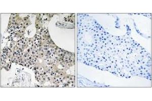 Immunohistochemistry analysis of paraffin-embedded human breast carcinoma tissue, using GPSN2 Antibody. (TECR antibody  (AA 259-308))