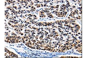 The image on the left is immunohistochemistry of paraffin-embedded Human lung cancer tissue using ABIN7189819(AP1B1 Antibody) at dilution 1/25, on the right is treated with synthetic peptide. (AP1B1 antibody)