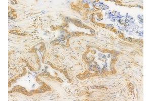 ABIN6262407 and ABIN6276441 at 1/100 staining human pancreatic carcinoma by IHC-P. (GRP94 antibody  (C-Term))