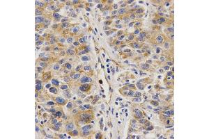 Immunohistochemistry of paraffin-embedded human liver cancer using VAPB Antibody. (VAPB antibody)