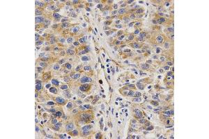 Immunohistochemistry of paraffin-embedded human liver cancer using VAPB Antibody. (VAPB antibody)