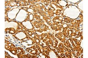 The image on the left is immunohistochemistry of paraffin-embedded Human thyroid cancer tissue using ABIN7190727(FZD6 Antibody) at dilution 1/60, on the right is treated with synthetic peptide.