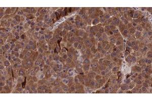 ABIN6277155 at 1/100 staining Human liver cancer tissue by IHC-P. (Integrin beta 2 antibody  (N-Term))