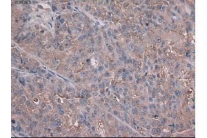 Immunohistochemical staining of paraffin-embedded Adenocarcinoma of colon using anti-Trim33 (ABIN2452534) mouse monoclonal antibody. (TRIM33 antibody  (AA 887-1046))