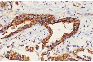 Immunohistochemistry of paraffin-embedded Human pancreatic cancer using K1KB3 Ployclonal Antibody at dilution of 1:200. (KLK1B3 antibody)