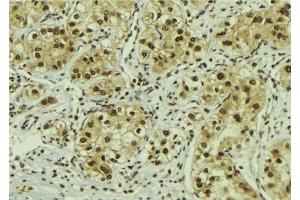 ABIN6267118 at 1/100 staining Human breast cancer tissue by IHC-P. (FOXO3 antibody  (pSer7))