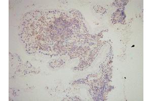 SNAI2 Antibody(ABIN6276471) staining human cervical carcinoma tissue sections by IHC-f at 1:200.