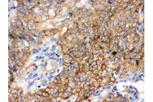 Anti- Bag3 Picoband antibody, IHC(P) IHC(P): Human Lung Cancer Tissue (BAG3 antibody  (AA 100-561))
