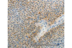 Immunohistochemistry of Human liver cancer using AGAP1 Polyclonal Antibody at dilution of 1:25 (AGAP1 antibody)