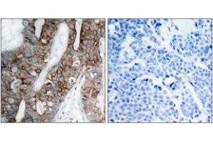Immunohistochemistry analysis of paraffin-embedded human breast carcinoma tissue, using Integrin beta3 (Ab-773) Antibody. (Integrin beta 3 antibody  (AA 731-780))