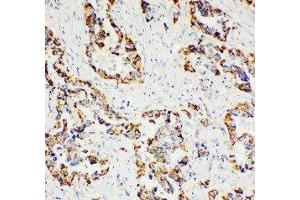 Anti-Paxillin antibody, IHC(P) IHC(P): Human Lung Cancer Tissue (Paxillin antibody  (C-Term))