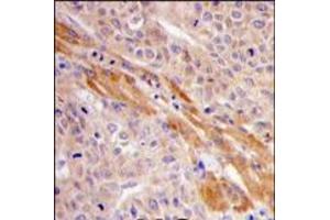 Formalin-fixed and paraffin-embedded human hepatocarcinoma tissue reacted with PGK1 Antibody (Center), which was peroxidase-conjugated to the secondary antibody, followed by DAB staining. (PGK1 antibody  (Middle Region))
