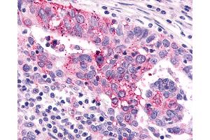 Anti-GRM6 / MGLUR6 antibody IHC of human Ovary, Carcinoma. (Metabotropic Glutamate Receptor 6 antibody  (N-Term))