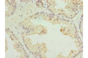 Immunohistochemistry of paraffin-embedded human prostate cancer using ABIN7164481 at dilution of 1:100