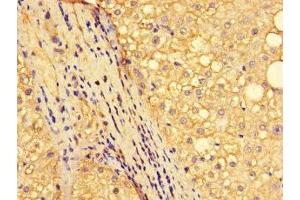 Immunohistochemistry of paraffin-embedded human liver cancer using ABIN7161893 at dilution of 1:100 (NR1D1 antibody  (AA 246-558))