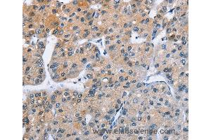 Immunohistochemistry of Human liver cancer using ATXN1 Polyclonal Antibody at dilution of 1:40
