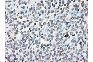 Immunohistochemical staining of paraffin-embedded Adenocarcinoma of colon tissue using anti-PLK1mouse monoclonal antibody. (PLK1 antibody)