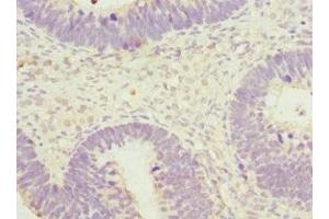Immunohistochemistry of paraffin-embedded human ovarian cancer using ABIN7170599 at dilution of 1:100