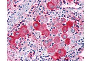 Anti-GPR63 antibody IHC of human Skin, Melanoma. (GPR63 antibody  (C-Term))